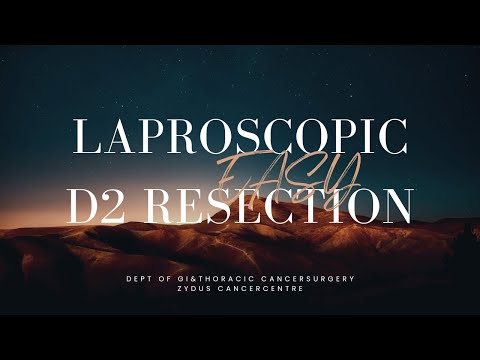 Laparoscopic D2 gastrectomy