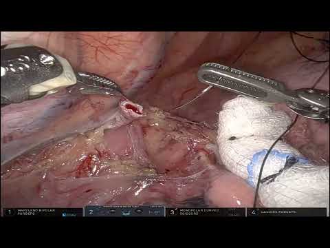 Supra azygous lymph node dissection