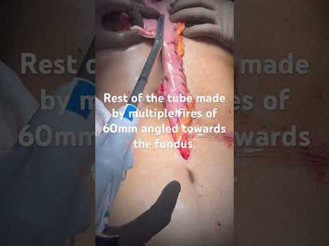 Stomach tube for oesophageal replacement