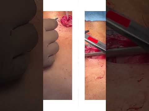Side-to-side oesophago-gastrostomy