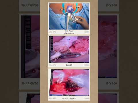 TAMIS for early rectal cancer